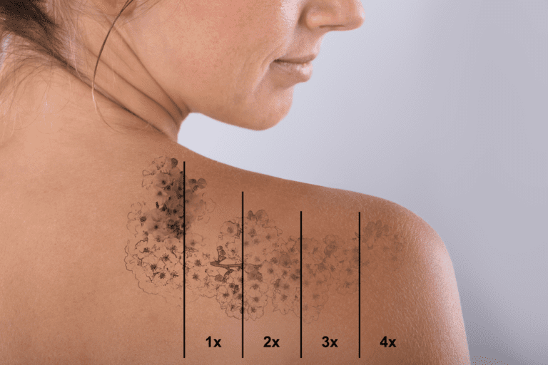 How Long Does Laser Tattoo Removal Take? Rejuvene MD