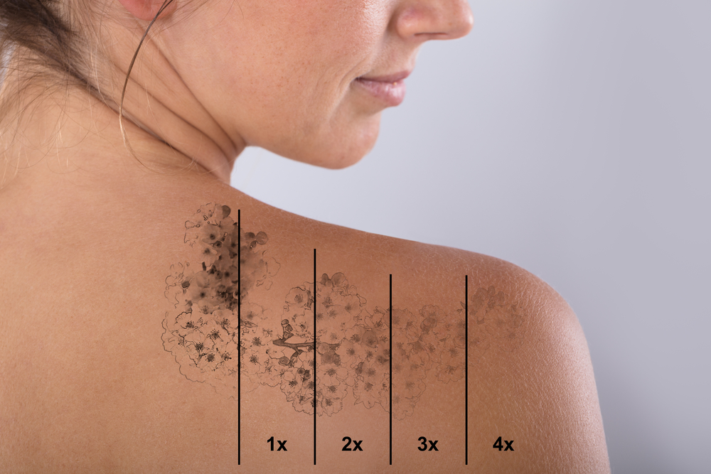 Laser Tattoo Removal - Salmon Creek Plastic Surgery