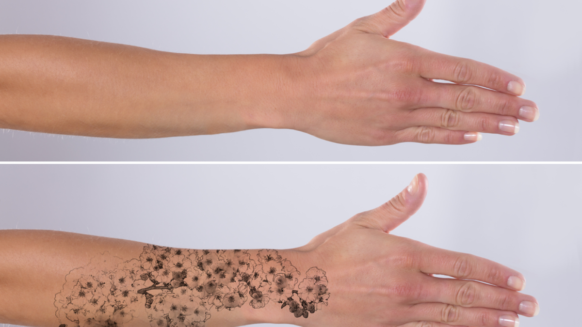 How Many Sessions of Laser Tattoo Removal Do You Need? - Rejuvene MD