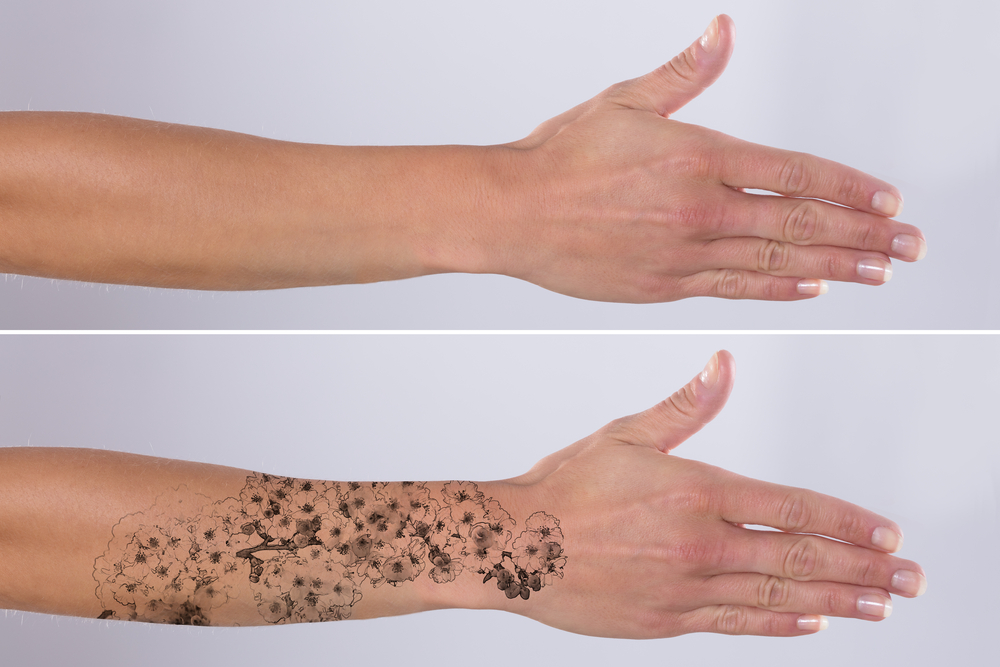 How_Many_Sessions_of_Laser_Tattoo_Removal_Do_You_Need_637792981181272748