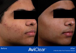 AviClear Laser Acne Treatment in El Paso, Texas