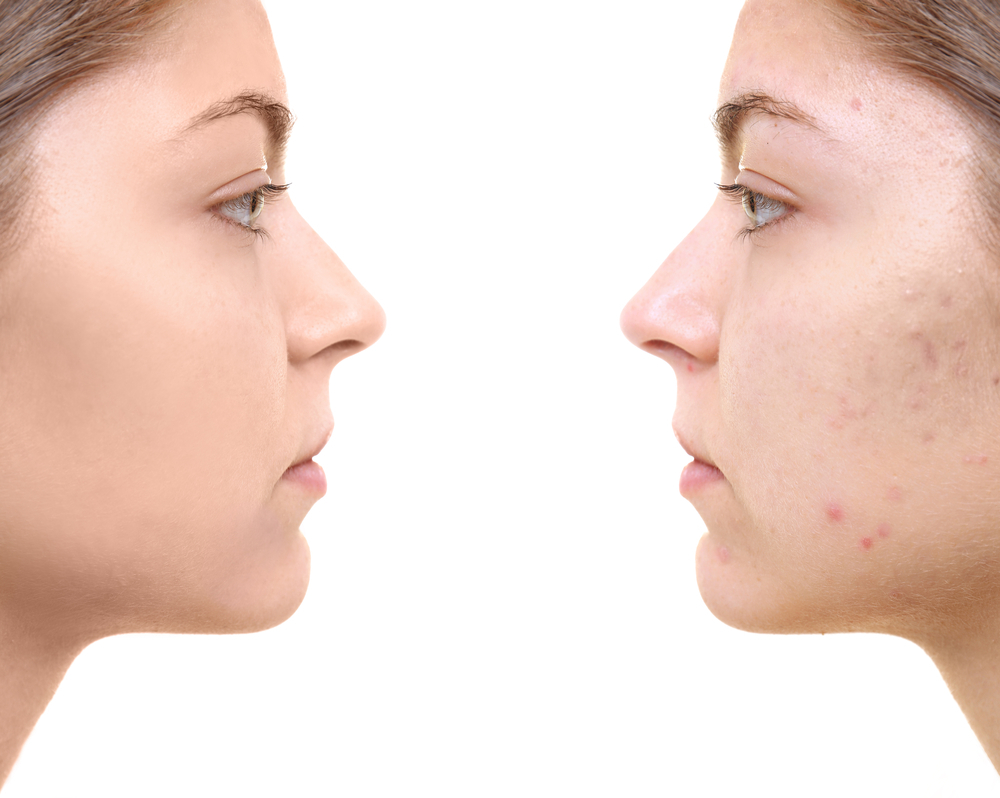 Acne Scar Treatment in El Paso, TX | Rejuvené MD